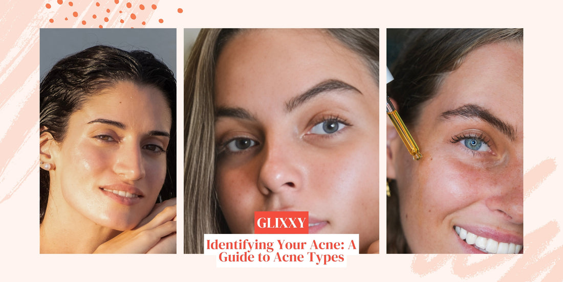 Identifying Your Acne: A Guide to Acne Types