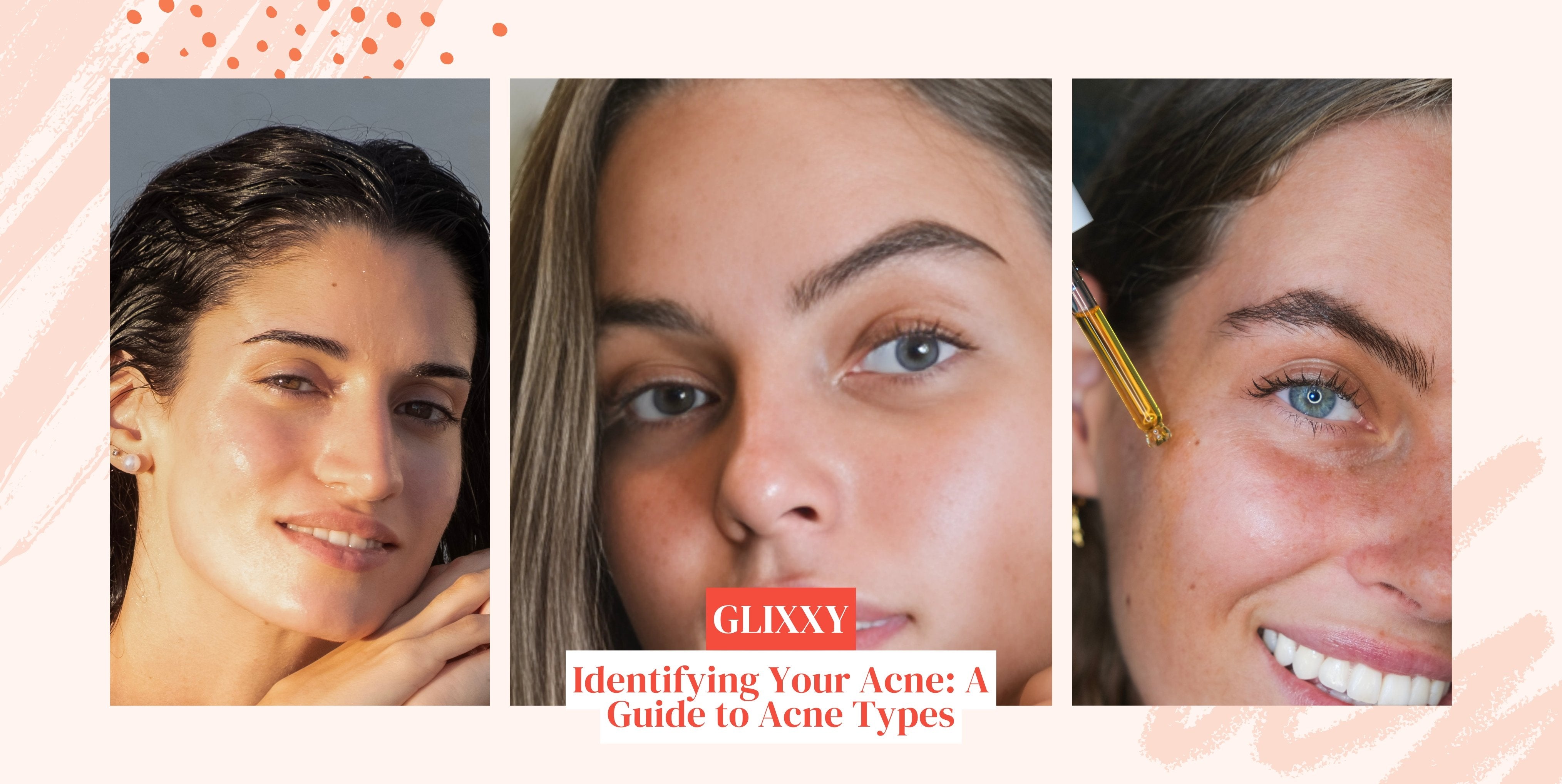 Identifying Your Acne: A Guide to Acne Types